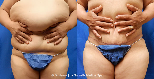 Tummy Tuck Ventura County, Abdominosplasty Before and After Photos by Dr. Hanna, La Nouvelle Medical Spa, Oxnard