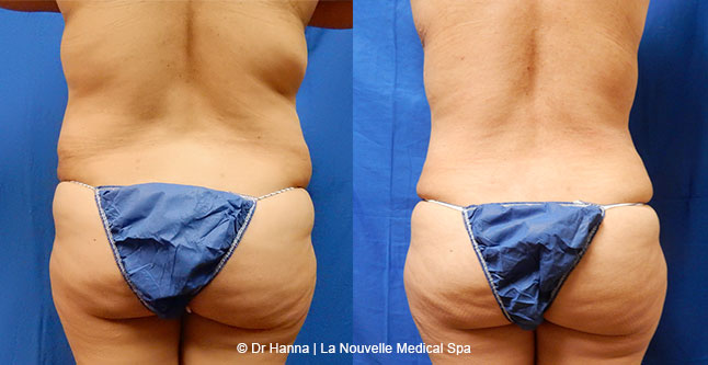 Tummy Tuck Ventura County, Abdominosplasty Before and After Photos by Dr. Hanna, La Nouvelle Medical Spa, Oxnard