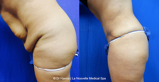 Tummy Tuck Ventura County, Abdominosplasty Before and After Photos by Dr. Hanna, La Nouvelle Medical Spa, Oxnard