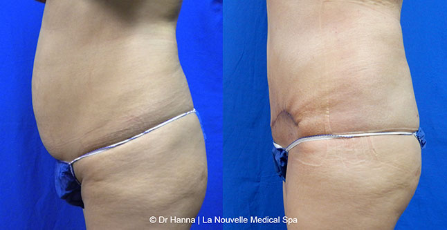 Tummy Tuck Ventura County, Abdominosplasty Before and After Photos by Dr. Hanna, La Nouvelle Medical Spa, Oxnard