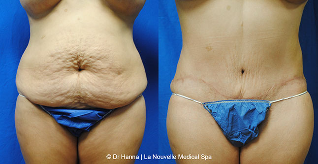 Tummy Tuck Ventura County, Abdominosplasty Before and After Photos by Dr. Hanna, La Nouvelle Medical Spa, Oxnard