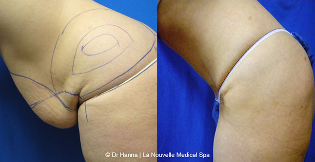 Tummy Tuck Ventura County, Abdominosplasty Before and After Photos by Dr. Hanna, La Nouvelle Medical Spa, Oxnard