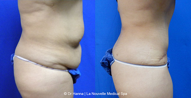 Tummy Tuck Ventura County, Abdominosplasty Before and After Photos by Dr. Hanna, La Nouvelle Medical Spa, Oxnard