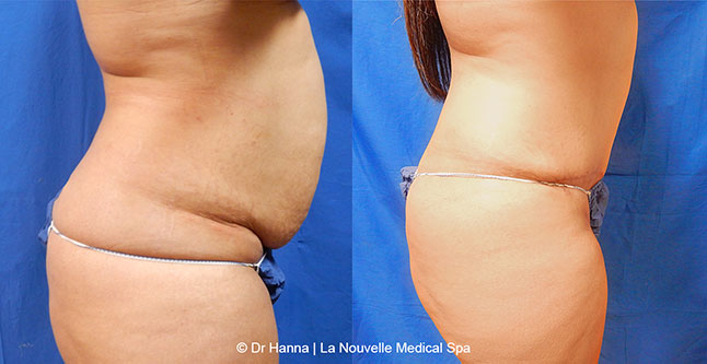 Tummy Tuck Ventura County, Abdominosplasty Before and After Photos by Dr. Hanna, La Nouvelle Medical Spa, Oxnard