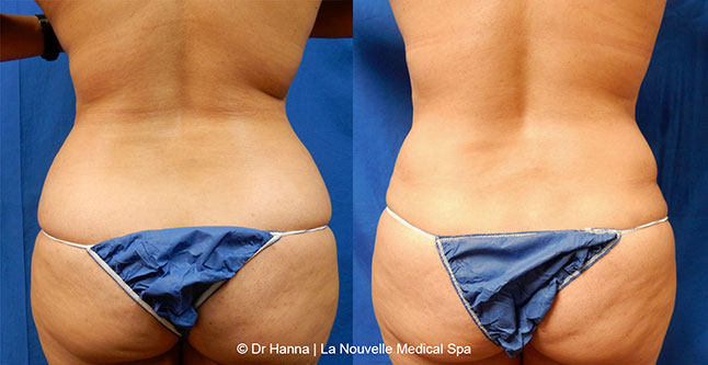 Tummy Tuck Ventura County, Abdominosplasty Before and After Photos by Dr. Hanna, La Nouvelle Medical Spa, Oxnard