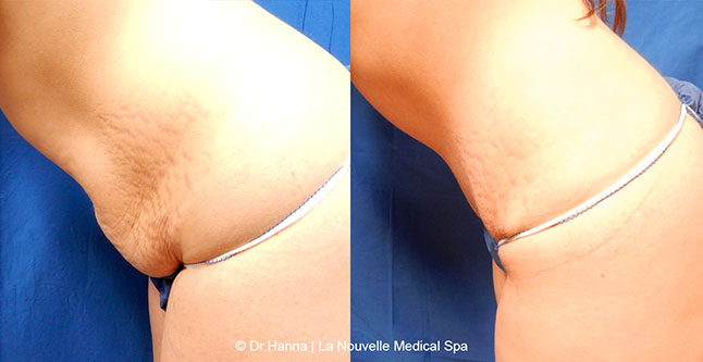 Tummy Tuck Ventura County, Abdominosplasty Before and After Photos by Dr. Hanna, La Nouvelle Medical Spa, Oxnard