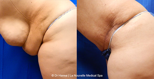 Tummy Tuck Ventura County, Abdominosplasty Before and After Photos by Dr. Hanna, La Nouvelle Medical Spa, Oxnard
