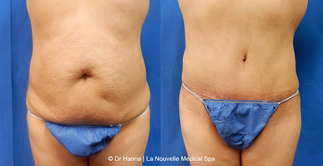 Tummy Tuck Ventura County, Abdominosplasty Before and After Photos by Dr. Hanna, La Nouvelle Medical Spa, Oxnard