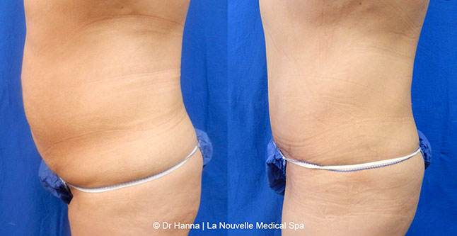 Tummy Tuck Ventura County, Abdominosplasty Before and After Photos by Dr. Hanna, La Nouvelle Medical Spa, Oxnard
