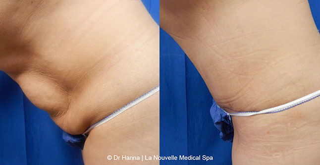 Tummy Tuck Ventura County, Abdominosplasty Before and After Photos by Dr. Hanna, La Nouvelle Medical Spa, Oxnard
