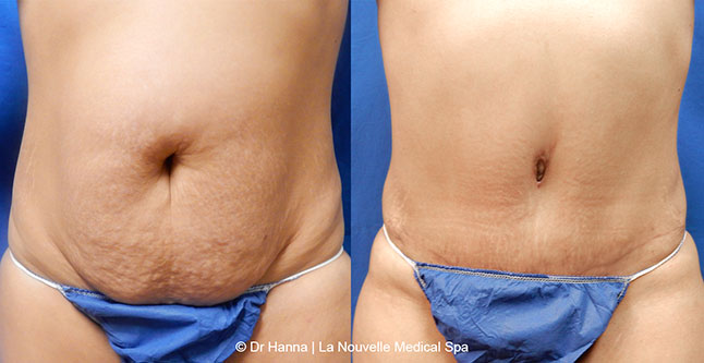 Tummy Tuck Ventura County, Abdominosplasty Before and After Photos by Dr. Hanna, La Nouvelle Medical Spa, Oxnard