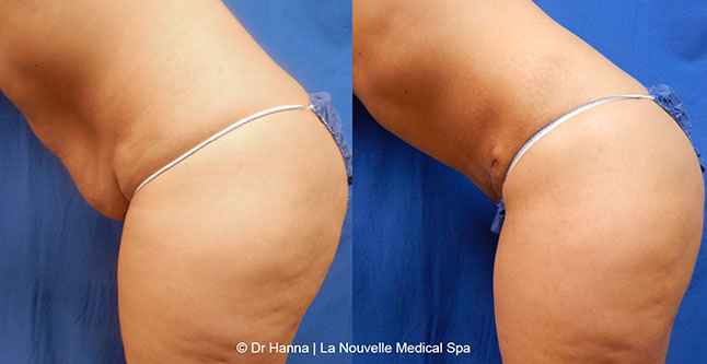 Tummy Tuck Ventura County, Abdominosplasty Before and After Photos by Dr. Hanna, La Nouvelle Medical Spa, Oxnard
