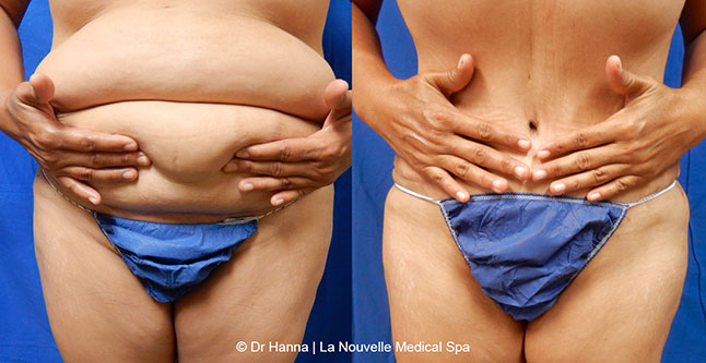 Tummy Tuck Ventura County, Abdominosplasty Before and After Photos by Dr. Hanna, La Nouvelle Medical Spa, Oxnard