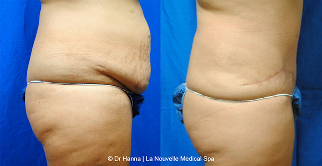 Tummy Tuck Ventura County, Abdominosplasty Before and After Photos by Dr. Hanna, La Nouvelle Medical Spa, Oxnard