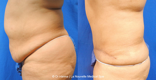 Tummy Tuck Ventura County, Abdominosplasty Before and After Photos by Dr. Hanna, La Nouvelle Medical Spa, Oxnard
