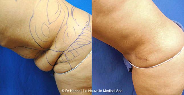 Tummy Tuck Ventura County, Abdominosplasty Before and After Photos by Dr. Hanna, La Nouvelle Medical Spa, Oxnard