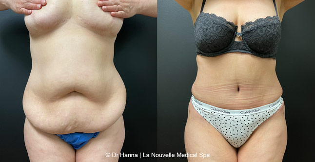 Tummy Tuck Ventura County, Abdominosplasty Before and After Photos by Dr. Hanna, La Nouvelle Medical Spa, Oxnard