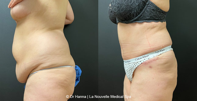 Tummy Tuck Before & After Ventura County, Abdominosplasty by Dr. Hanna, La Nouvelle Medical Spa, Oxnard