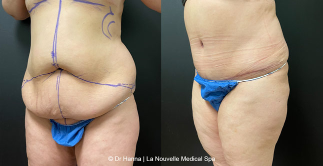 Tummy Tuck Before & After Ventura County, Abdominosplasty by Dr. Hanna, La Nouvelle Medical Spa, Oxnard