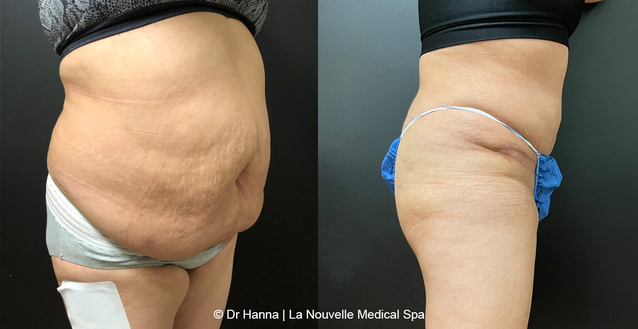 Tummy Tuck Ventura County, Abdominosplasty Before and After Photos by Dr. Hanna, La Nouvelle Medical Spa, Oxnard