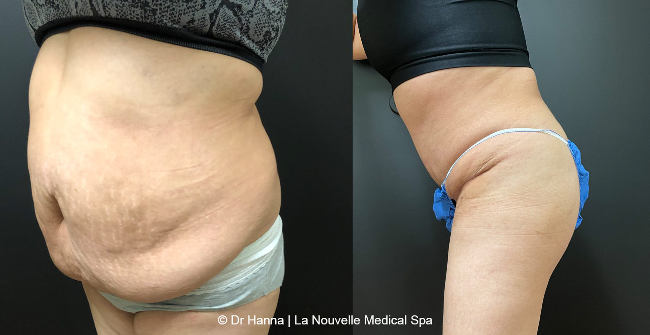 Tummy Tuck Ventura County, Abdominosplasty Before and After Photos by Dr. Hanna, La Nouvelle Medical Spa, Oxnard