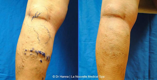Varicose Vein Removal with Phlebectomy before after photos, Dr. Hanna La Nouvelle Medical Spa, Oxnard, Ventura County