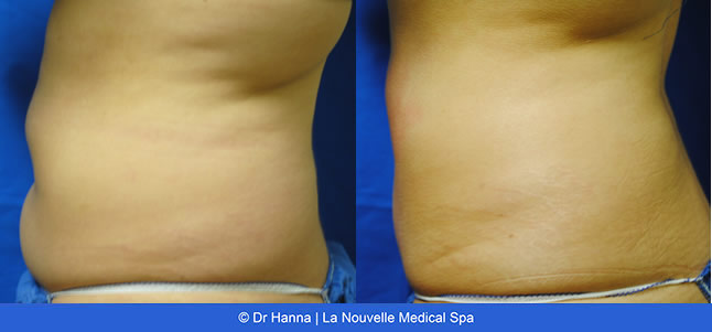 Vaser Shape non-invasive fat reduction before after photos, La Nouvelle Medical Spa, Oxnard, Ventura County