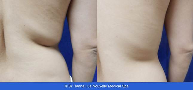 Vaser Shape non-invasive fat reduction before after photos, La Nouvelle Medical Spa, Oxnard, Ventura County