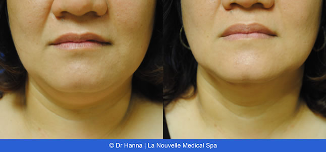Vaser Shape non-invasive fat reduction before after photos, La Nouvelle Medical Spa, Oxnard, Ventura County