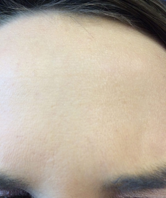 botox, dyspot, xeomin injections before after photos for wrinkle removal ventura oxnard dr hanna