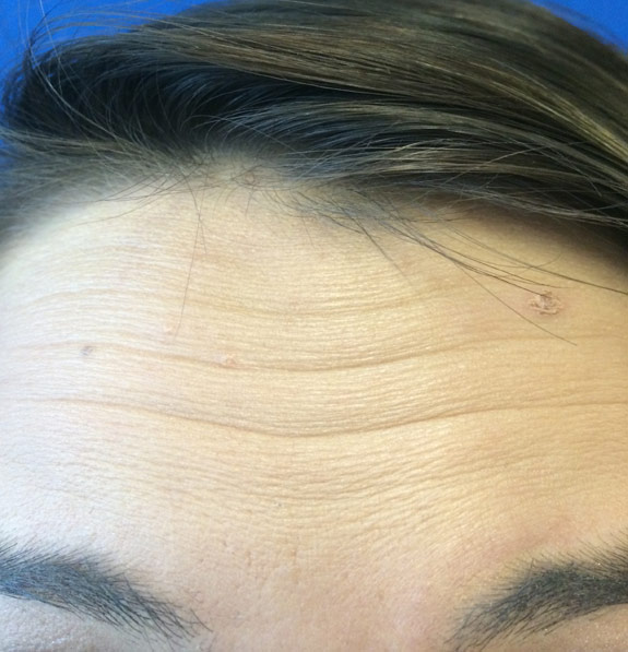 botox, dyspot, xeomin injections before after photos ventura oxnard
