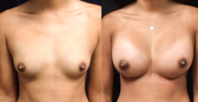 Breast augmentation before and after photos Ventura County, boob job with silicone implants by Dr. Hanna, La Nouvelle Medical Spa, 51