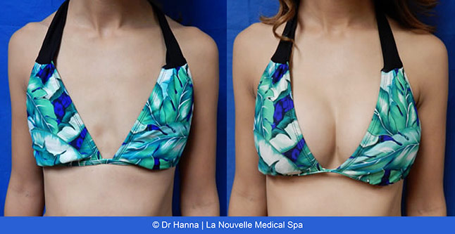 Breast augmentation before and after photos Ventura County, boob job with silicone implants by Dr. Hanna, La Nouvelle Medical Spa