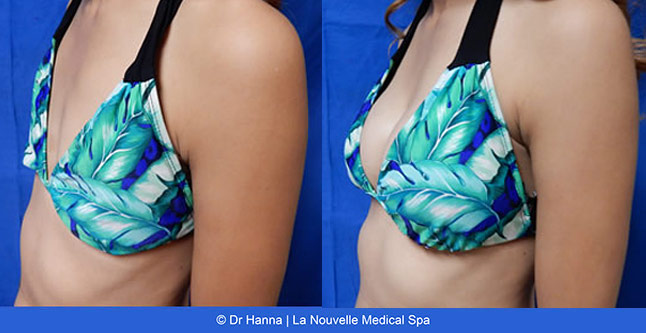 Breast augmentation before and after photos Ventura County, boob job with silicone implants by Dr. Hanna, La Nouvelle Medical Spa