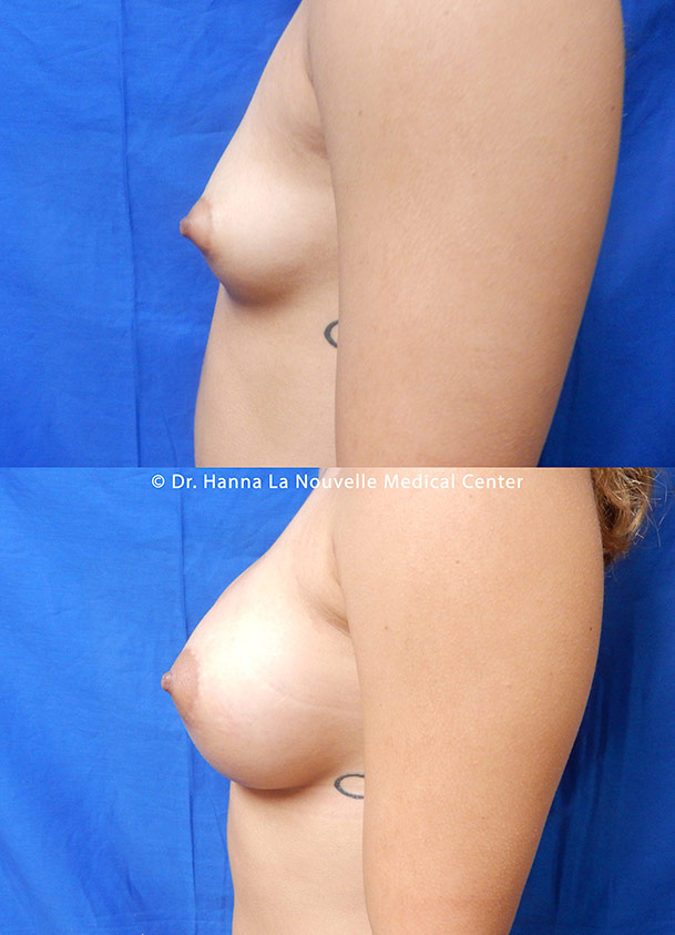 breast augmentation with silicone implants before after by dr antoine hanna ventura