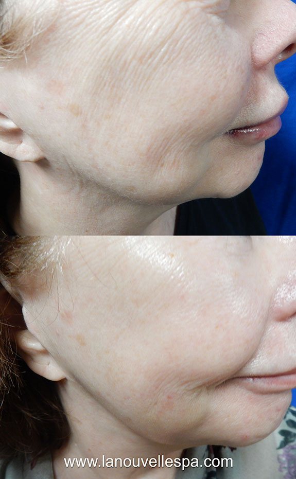 pi peel before after oxnard ventura