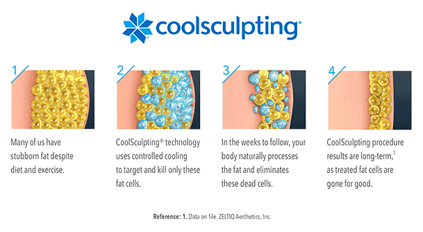 coolsculpting process