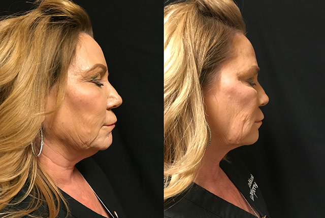 coolsculpting before after female neck la nouvelle medical spa oxnard