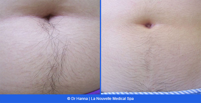 Laser Hair Removal Before and After Photos | Oxnard, Ventura