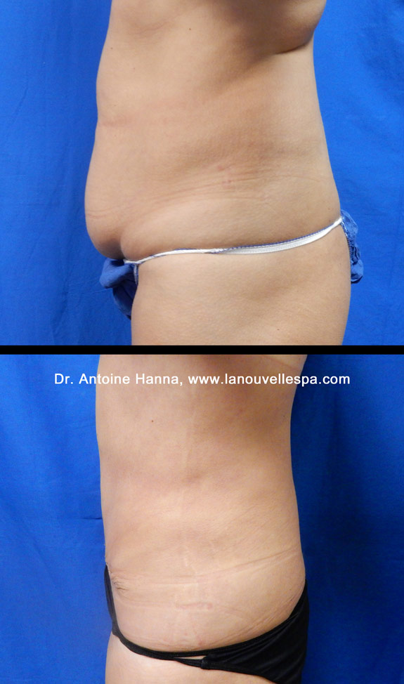Mini Tummy Tuck Before and After Photo Gallery, Los Angeles, CA