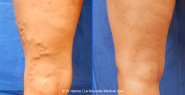 Varicose Vein Removal with Phlebectomy before after photos, Dr. Hanna La Nouvelle Medical Spa, Oxnard, Ventura County