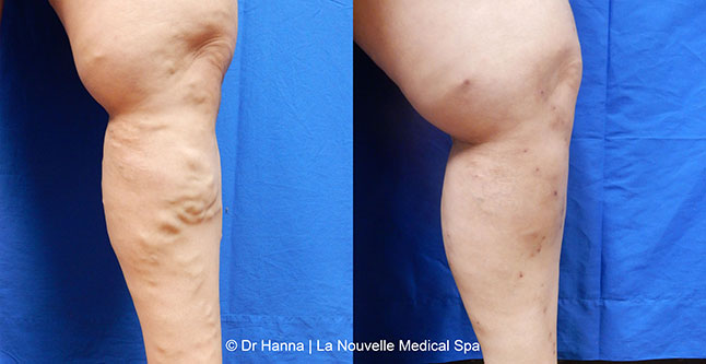 Varicose Vein Removal with Phlebectomy before after photos, Dr. Hanna La Nouvelle Medical Spa, Oxnard, Ventura County