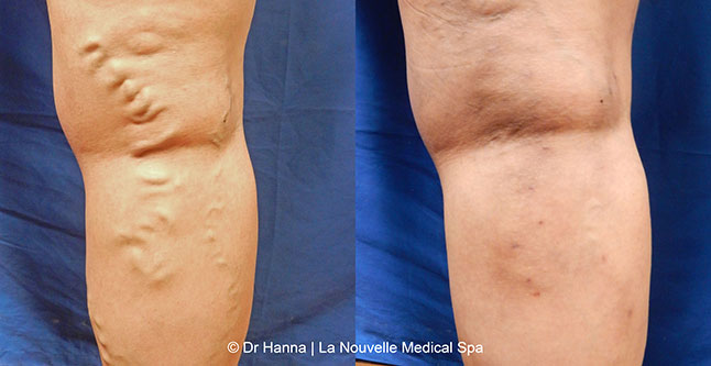 Varicose Vein Removal with Phlebectomy before after photos, Dr. Hanna La Nouvelle Medical Spa, Oxnard, Ventura County