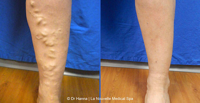 Varicose Vein Removal with Phlebectomy before after photos, Dr. Hanna La Nouvelle Medical Spa, Oxnard, Ventura County