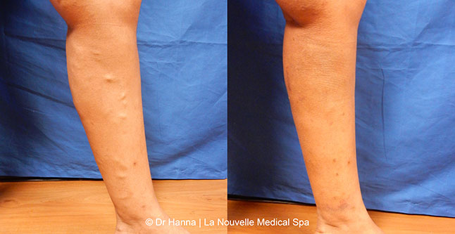 Varicose Vein Removal with Phlebectomy before after photos, Dr. Hanna La Nouvelle Medical Spa, Oxnard, Ventura County