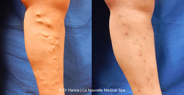 Varicose Vein Removal with Phlebectomy before after photos, Dr. Hanna La Nouvelle Medical Spa, Oxnard, Ventura County