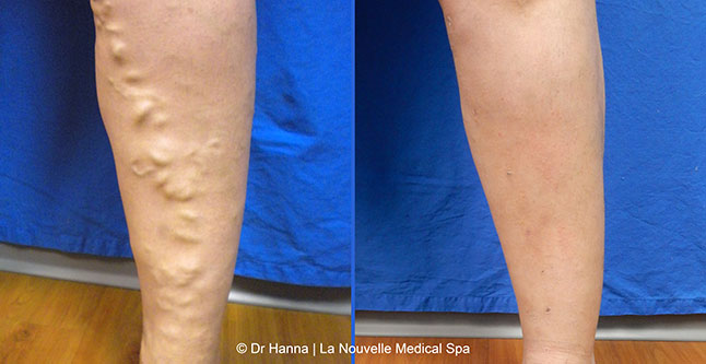 Varicose Vein Removal with Phlebectomy before after photos, Dr. Hanna La Nouvelle Medical Spa, Oxnard, Ventura county   