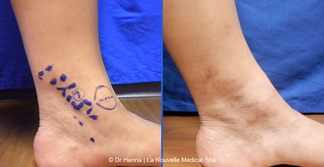 Varicose Vein Removal with Phlebectomy before after photos, Dr. Hanna La Nouvelle Medical Spa, Oxnard, Ventura County