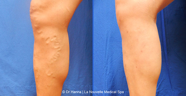 Varicose Vein Removal with Phlebectomy before after photos, Dr. Hanna La Nouvelle Medical Spa, Oxnard, Ventura County