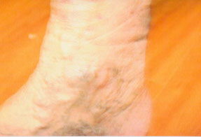 varicose laser vein removal ventura dr hanna